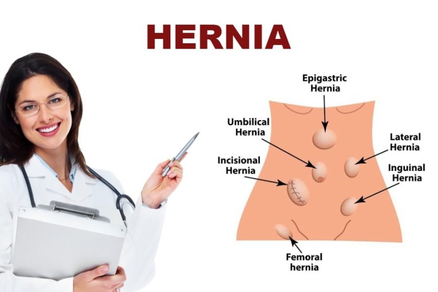 Hernia explanation
