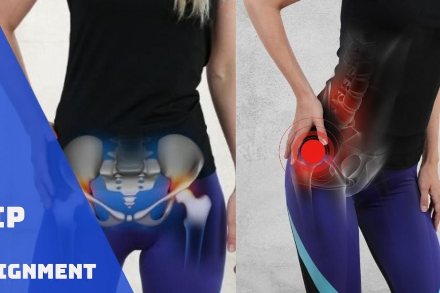 Hip Misalignment